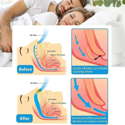 Dispositivo antirronquidos - EasySleep™